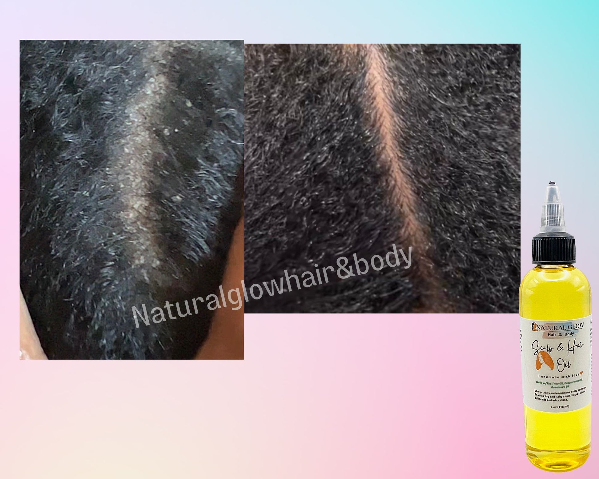 dry scalp oil